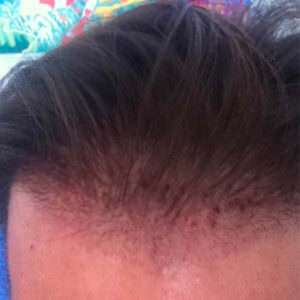 Healing Process Immediately After Hair Transplant Healing/Growth Process 