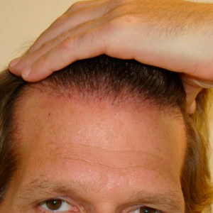 Healing Process Immediately After Hair Transplant Healing/Growth Process