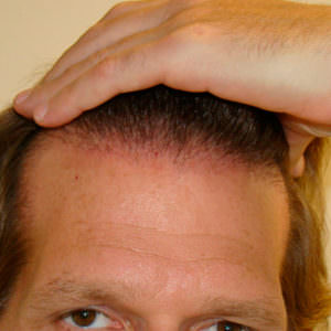 Healing Process Immediately After Hair Transplant Healing/Growth Process 