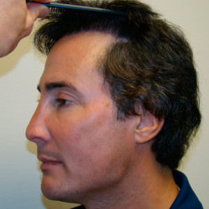 Completely Natural Hair Transplant Results Hair Transplant Industry Exposed Hairline 