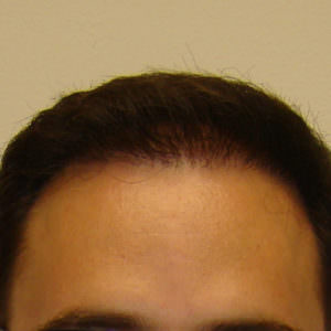 Pluggy Hair Transplant Correction Before And Afters Crown Difficult Cases Hairline
