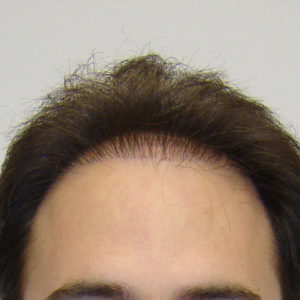 Pluggy Hair Transplant Correction Before And Afters Crown Difficult Cases Hairline 