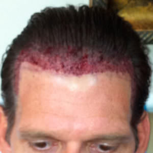 Healing Process Immediately After Hair Transplant Healing/Growth Process