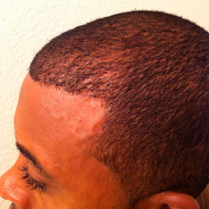 Hair Transplant On African American Male With Shaved Head African American Patients Before And Afters Hairline Suture Line/Scar 