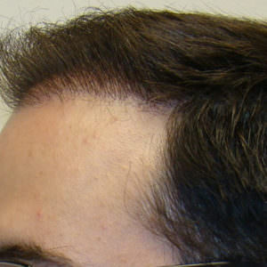 Pluggy Hair Transplant Correction Before And Afters Crown Difficult Cases Hairline 