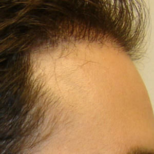 Pluggy Hair Transplant Correction Before And Afters Crown Difficult Cases Hairline 