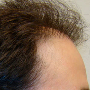 Pluggy Hair Transplant Correction Before And Afters Crown Difficult Cases Hairline 