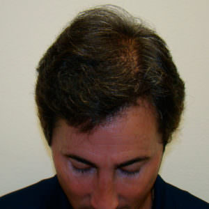 7 Prior Procedures Don't Compare To 1 Dr. Bolton Hair Transplant Before And Afters Crown Difficult Cases 