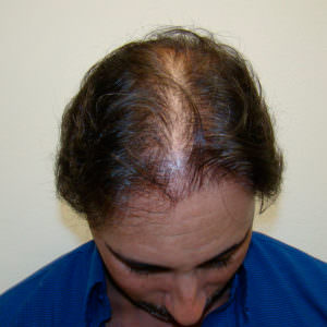Maximum Hair Density With MaxHarvest™ Hair Transplant Before And Afters Hairline 