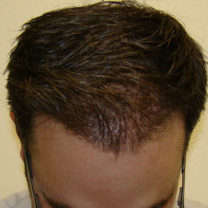 Pluggy Hair Transplant Correction Before And Afters Crown Difficult Cases Hairline 