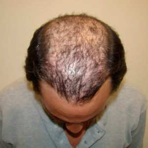 7 Prior Procedures Don't Compare To 1 Dr. Bolton Hair Transplant Before And Afters Crown Difficult Cases