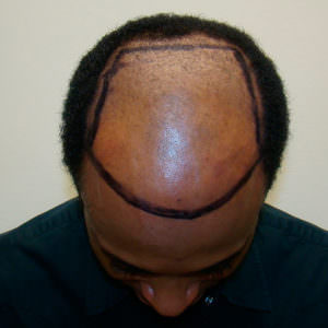 Hair Transplant On African American Male With Shaved Head African American Patients Before And Afters Hairline Suture Line/Scar 