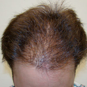 Pluggy Hair Transplant Correction Before And Afters Crown Difficult Cases Hairline 