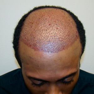 Hair Transplant On African American Male With Shaved Head African American Patients Before And Afters Hairline Suture Line/Scar 