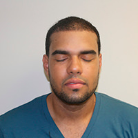 Severe Scarring Correctional Hair Transplant Procedure Before And Afters Crown Difficult Cases Hair Transplant Industry Exposed Hairline Healing/Growth Process Suture Line/Scar 