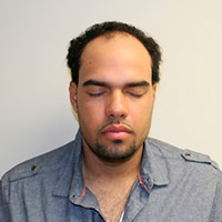 Severe Scarring Correctional Hair Transplant Procedure Before And Afters Crown Difficult Cases Hair Transplant Industry Exposed Hairline Healing/Growth Process Suture Line/Scar 
