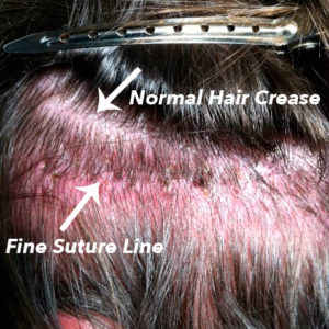 Post-Hair Transplant Scar Hair Transplant Industry Exposed Healing/Growth Process Suture Line/Scar 