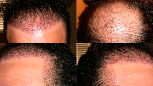 6 Month Correctional Procedure - Hair Transplant Progress Journal Healing/Growth Process