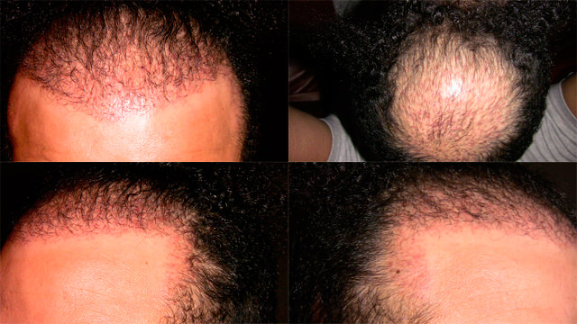 6 Month Correctional Procedure - Hair Transplant Progress Journal Healing/Growth Process 