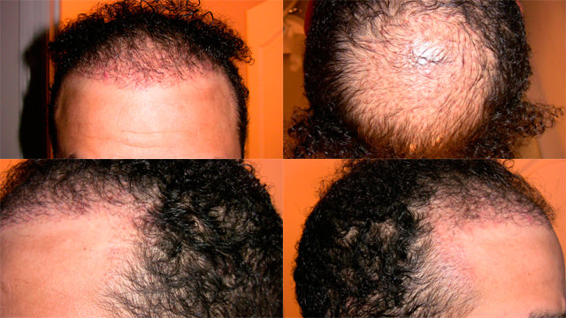 6 Month Correctional Procedure - Hair Transplant Progress Journal Healing/Growth Process 