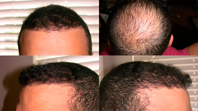 6 Month Correctional Procedure - Hair Transplant Progress Journal Healing/Growth Process 