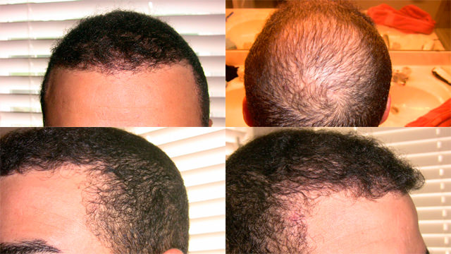 6 Month Correctional Procedure - Hair Transplant Progress Journal Healing/Growth Process 