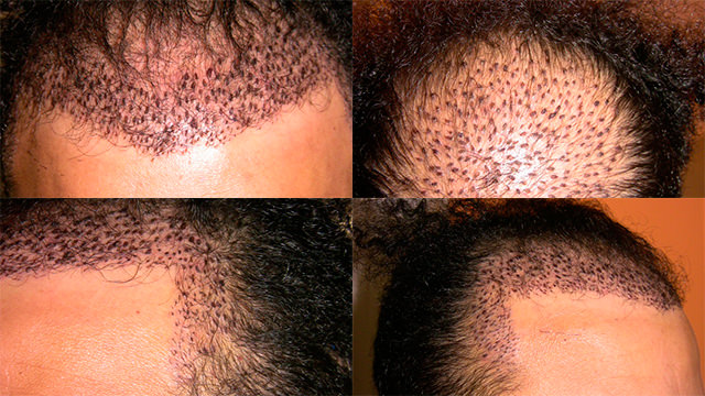 6 Month Correctional Procedure - Hair Transplant Progress Journal Healing/Growth Process 