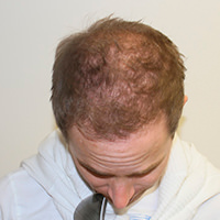 Anders' Hair Transplant Makeover Before And Afters Difficult Cases Hairline Healing/Growth Process