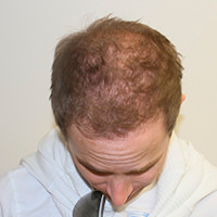 Anders' Hair Transplant Makeover Before And Afters Difficult Cases Hairline Healing/Growth Process 