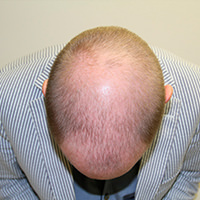 Anders' Hair Transplant Makeover Before And Afters Difficult Cases Hairline Healing/Growth Process 