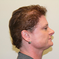 Female Hair Loss? No Problem. Before And Afters Hairline Women 