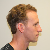 Young Man's 5 Month Transformation After MaxHarvest™ Procedure Before And Afters 