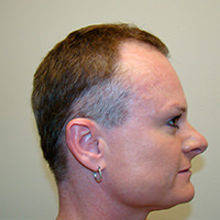 Female Hair Loss? No Problem. Before And Afters Hairline Women