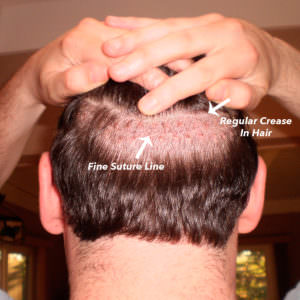 Suture Line With A Shaved Head After Hair Transplant - Undetectable Scar Hair Transplant Industry Exposed Healing/Growth Process Suture Line/Scar 