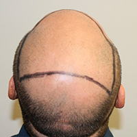 Open Up Your Hair Styling Options After A Hair Transplant Before And Afters Crown Difficult Cases Hairline Healing/Growth Process 