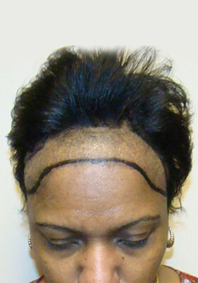 African American Female Hair Transplant Results African American Patients Before And Afters Hairline Healing/Growth Process Women 