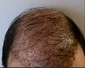 Absolute Disaster - FUE Hair Transplant In Turkey Difficult Cases FUE Corrections Hair Transplant Industry Exposed 