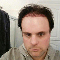 Dr. Bolton - Great Hair Transplants Updates Tony from St. Louis Missouri Reviews His Hair Transplant Procedure Hair Transplant Industry Exposed Healing/Growth Process Testimonials