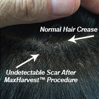 Researching Your Hair Transplant Options FUE Corrections Hair Transplant Industry Exposed Suture Line/Scar 