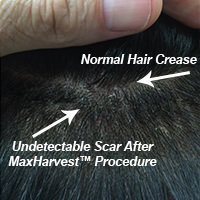 Dr. Bolton - Great Hair Transplants Updates Researching Your Hair Transplant Options FUE Corrections Hair Transplant Industry Exposed Suture Line/Scar