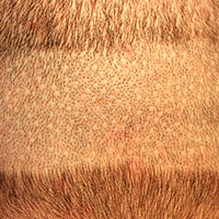 Dr. Bolton - Great Hair Transplants Updates Researching Your Hair Transplant Options FUE Corrections Hair Transplant Industry Exposed Suture Line/Scar