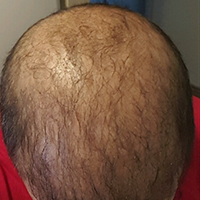 Considering A Budget Hair Transplant Procedure? Difficult Cases FUE Corrections Hair Transplant Industry Exposed