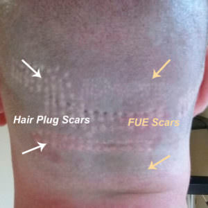 FUE Hair Transplants Are NOT Scar-less FUE Corrections Hair Transplant Industry Exposed Suture Line/Scar Testimonials 