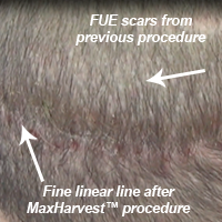 FUE Hair Transplants Are NOT Scar-less FUE Corrections Hair Transplant Industry Exposed Suture Line/Scar Testimonials 