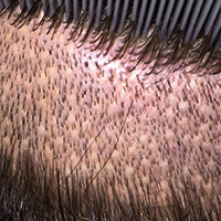 FUE Hair Transplants Are NOT Scar-less FUE Corrections Hair Transplant Industry Exposed Suture Line/Scar Testimonials 