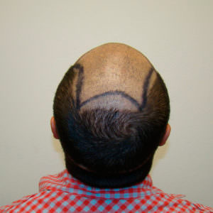 Dr. Bolton - Great Hair Transplants Updates Don't Set Yourself Up For Failure By Opting For A Cheap Hair Transplant Hair Transplant Industry Exposed