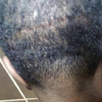 Unsatisfied With Another Doctor's Work? Corrective Hair Transplants Are Dr. Bolton's Specialty African American Patients Before And Afters Crown Difficult Cases Hairline Suture Line/Scar 