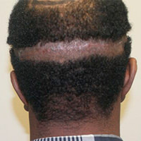 Unsatisfied With Another Doctor's Work? Corrective Hair Transplants Are Dr. Bolton's Specialty African American Patients Before And Afters Crown Difficult Cases Hairline Suture Line/Scar 