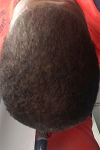 Unsatisfied With Another Doctor's Work? Corrective Hair Transplants Are Dr. Bolton's Specialty African American Patients Before And Afters Crown Difficult Cases Hairline Suture Line/Scar 