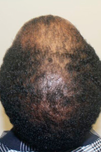 Unsatisfied With Another Doctor's Work? Corrective Hair Transplants Are Dr. Bolton's Specialty African American Patients Before And Afters Crown Difficult Cases Hairline Suture Line/Scar 